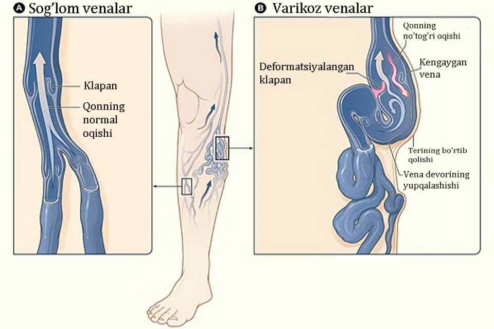 Fejlődési okai, tünetei és kezelése az alsó végtagi varixos vénákban - Zúzódások