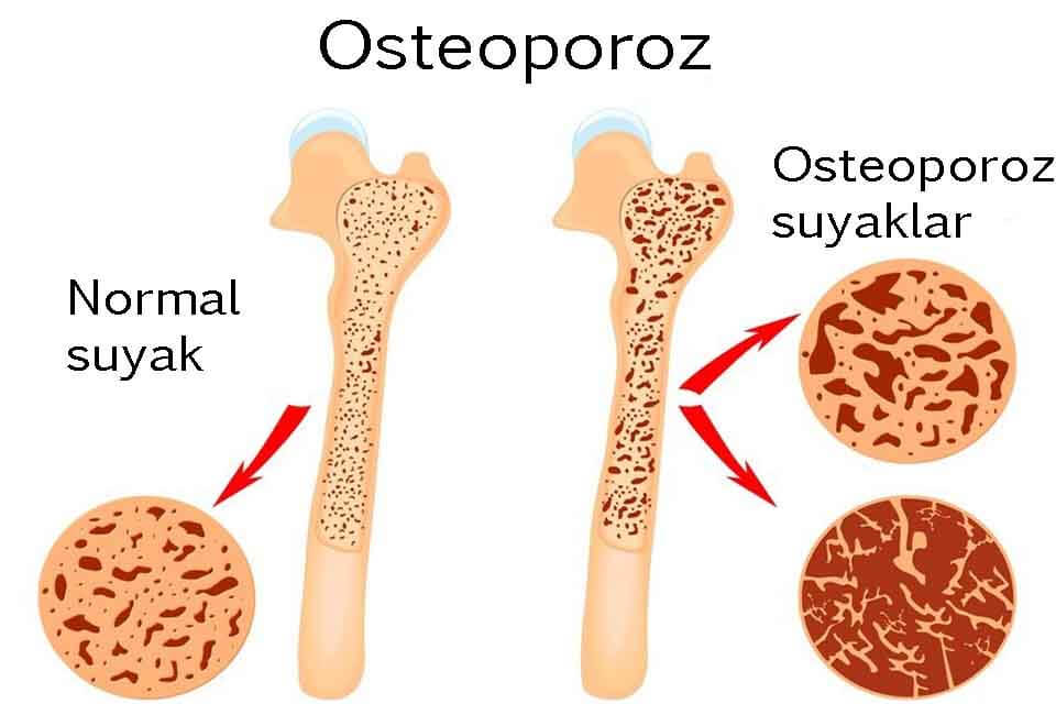 Osteoporozda suyaklarning tuzilishi