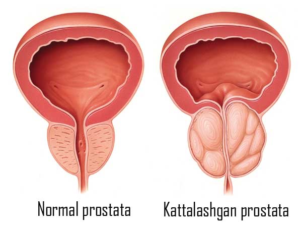 Prostata - normal va kattalashgan